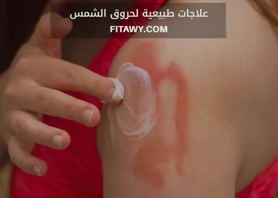 علاجات طبيعية لحروق الشمس